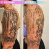 The Tattoo Removal